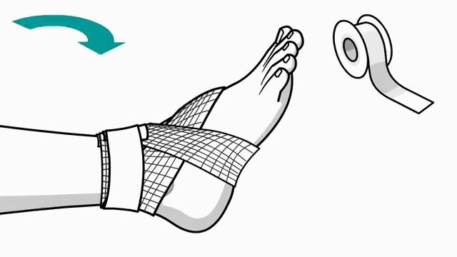 崴脚了用什么加压包扎,打篮球崴脚加压包扎