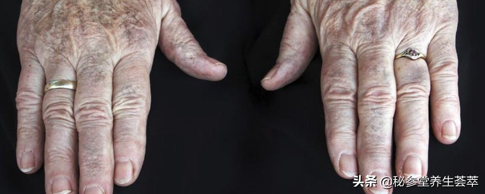 手上长老年斑用什么去掉,最近手上长老年斑怎么办