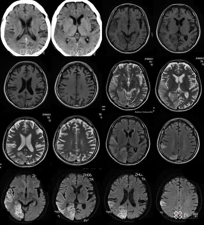 宫颈癌放射性治疗需要多长时间,宫颈癌放射治疗方法有哪些