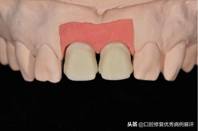 展评优秀病例赏析|Asc全瓷角度基台一体冠进行种植前牙美学修复