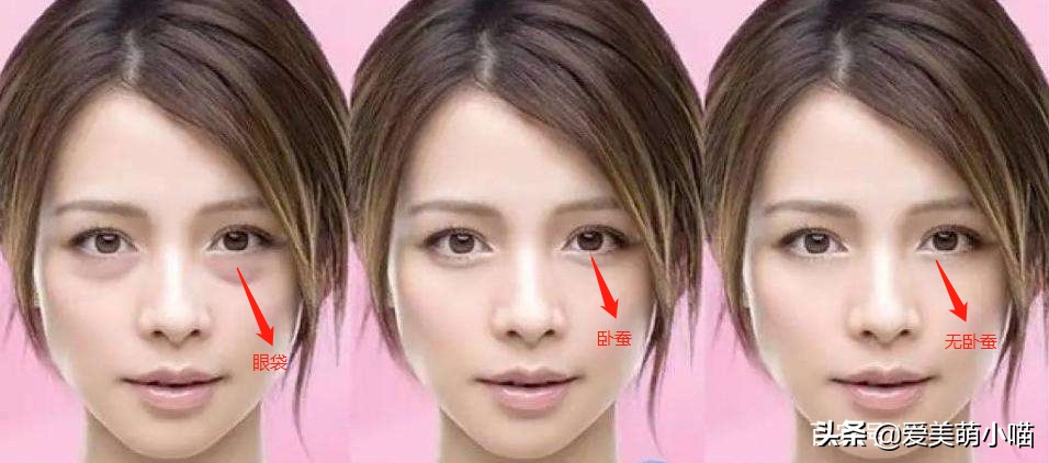 一张图分清散光和近视,眼袋和卧蚕的区分方法