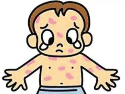 头孢克肟过敏皮疹是出在什么地方,头孢过敏症状图片皮疹