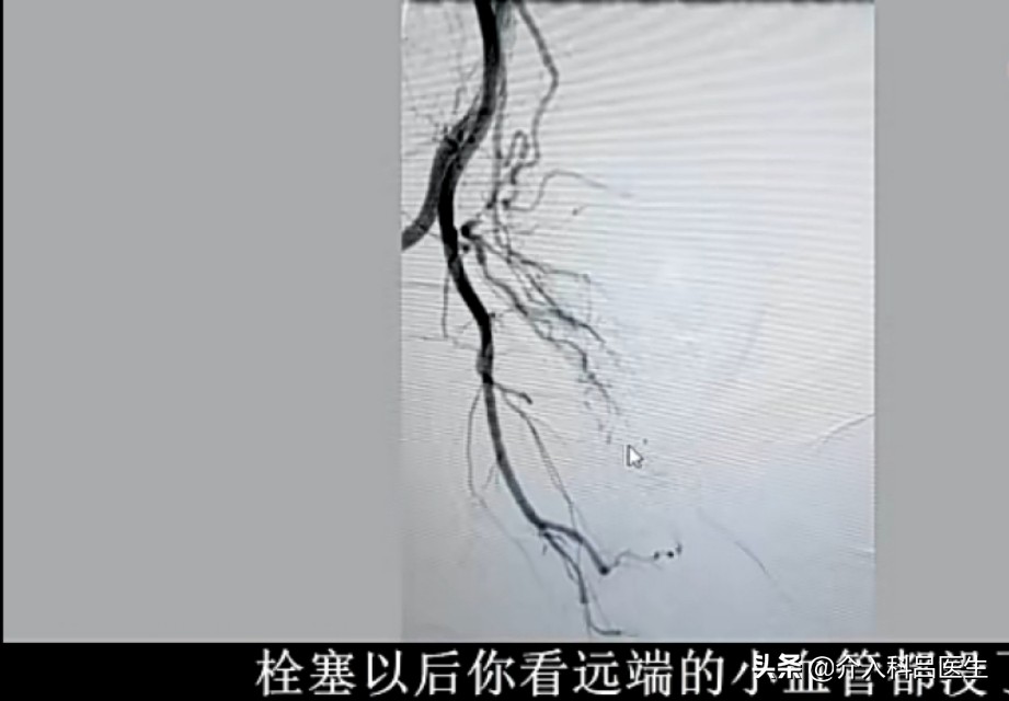 不死的癌症子宫腺肌瘤,子宫腺肌症介入栓塞效果和后遗症