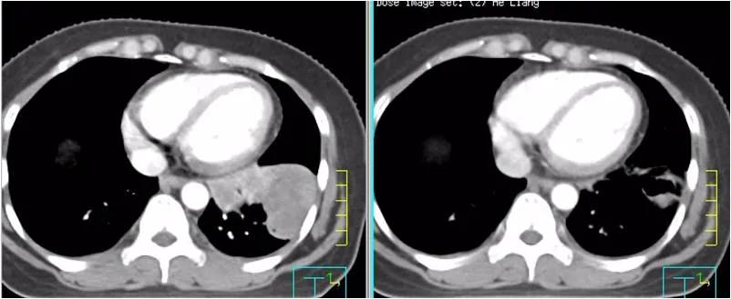 免疫疗法治鳞癌是可单独实施吗,肺转移性鳞癌免疫组化