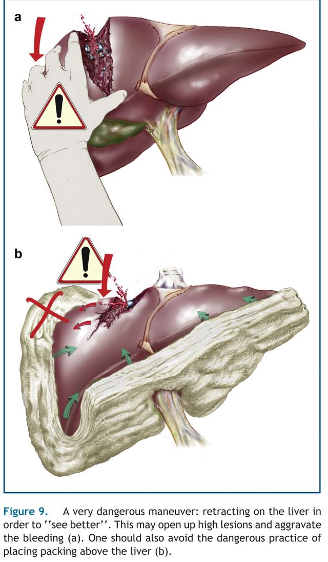 肝脏损伤的诊断和处理,肝脏损伤ii级