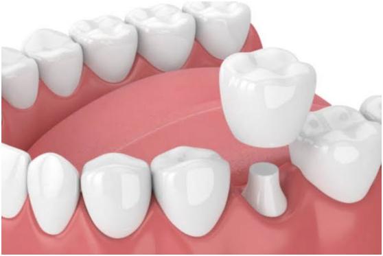 明星的烤瓷牙都怎么样了,明星都爱的烤瓷牙原来是这样的