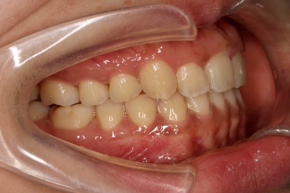 西安张军正畸医生如何,西安牙齿矫正案例