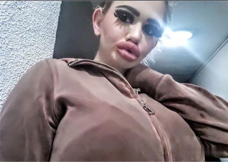 20次整容成功的女人,22岁女人做20次丰唇手术