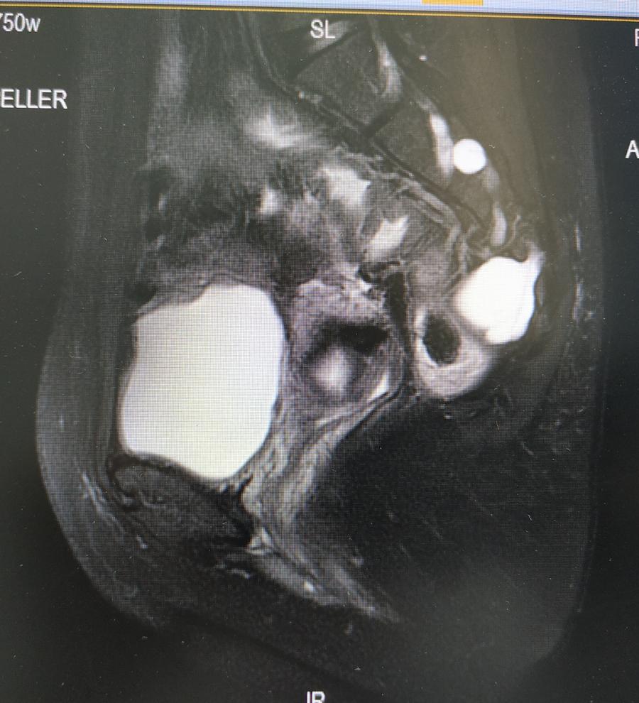盆腔包块怎么得的,病例分享案例