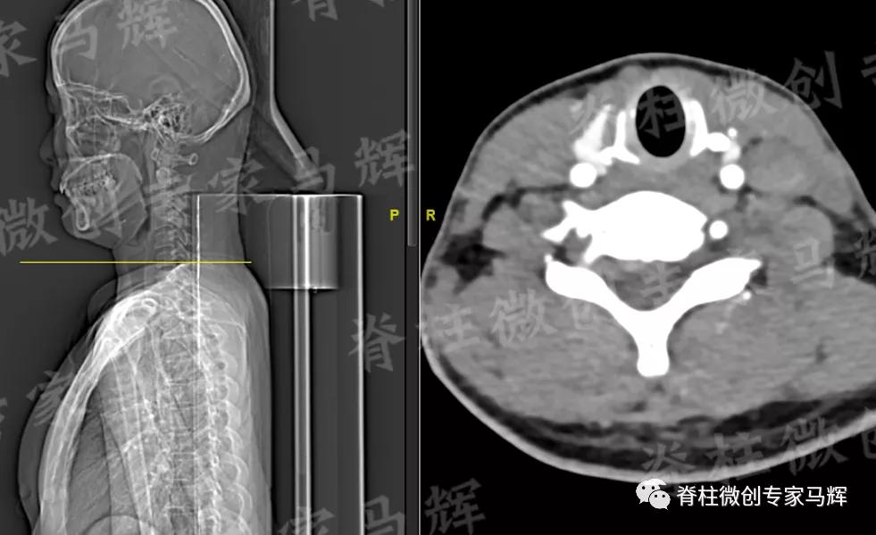 脊椎狭窄压迫神经腿疼怎么治疗,神经根痛上肢麻木怎么康复