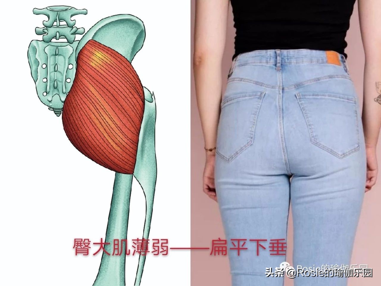 臀部两侧凹陷需要做骨盆修复吗,臀部两侧凹陷的形体改善