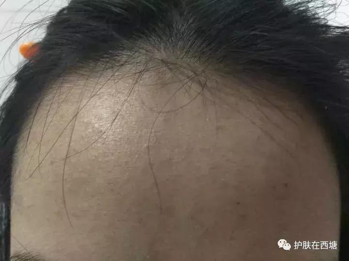 25岁痘痘还是反反复复不好,下巴痘痘反反复复是什么原因