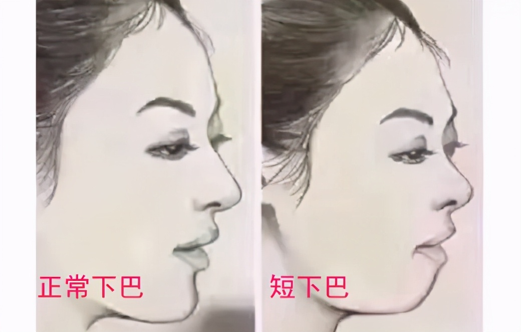 下巴短小和后缩嘴凸起好吗,下巴短小后缩但又有双下巴