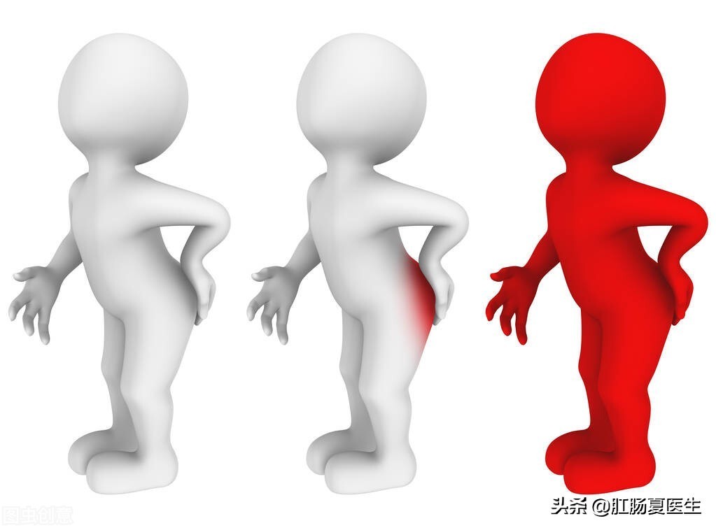 肛周脓肿到底是个什么东西,最轻微的肛周脓肿是什么表现