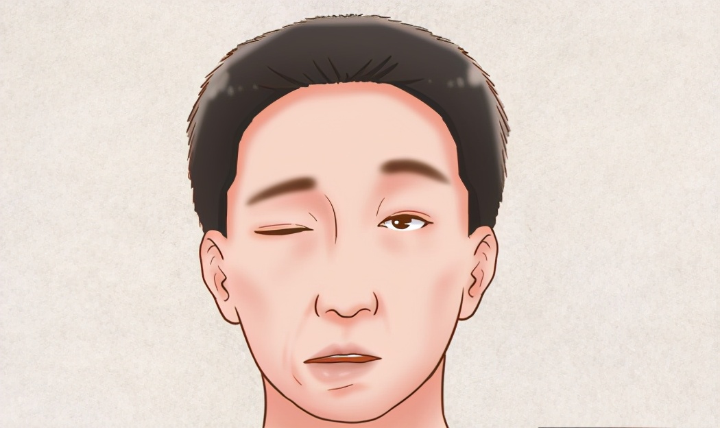 29岁姑娘瘦脸针后面瘫,29岁姑娘打了瘦脸针就面瘫