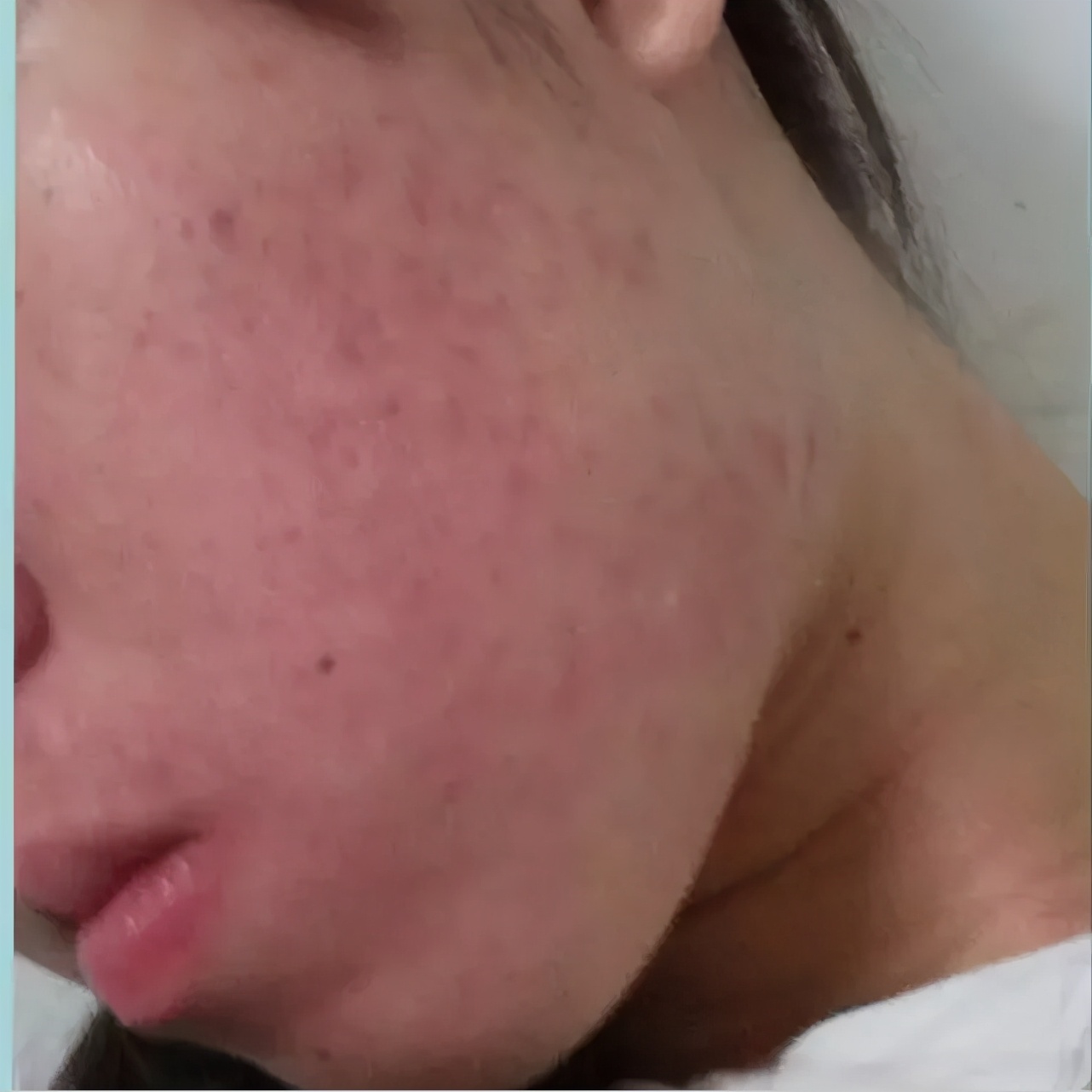 异维a酸软胶囊治疗痘痘多久见效,异维a酸抑制雄性激素治疗痘痘吗