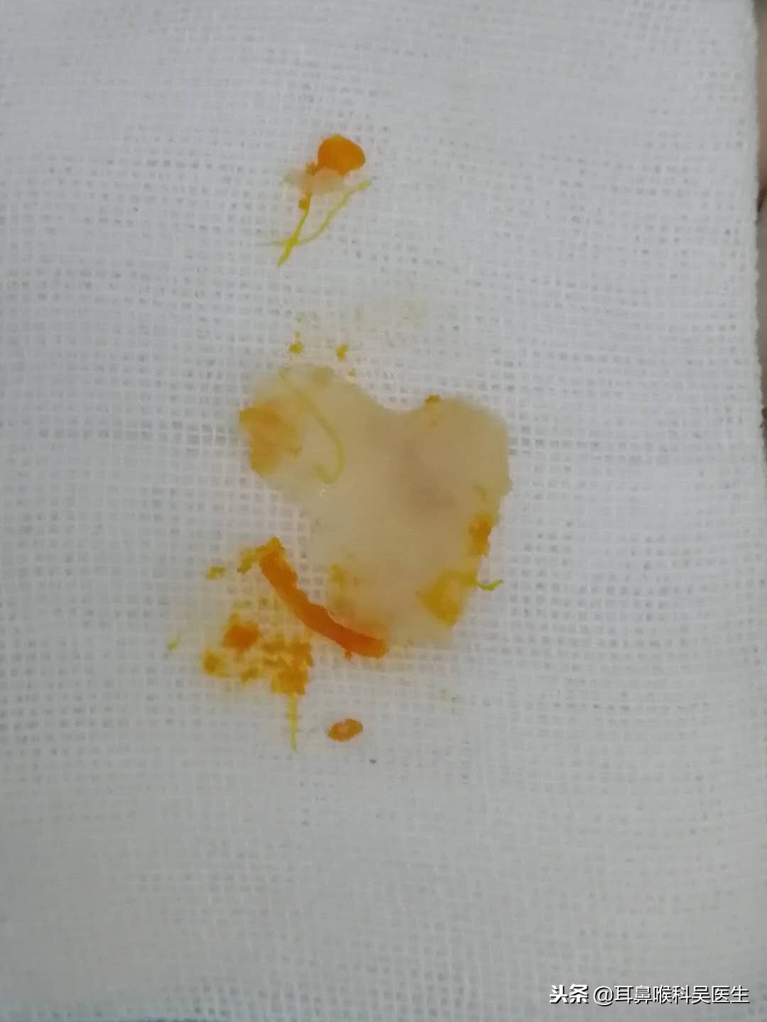 气管卡住异物怎样排出,被异物卡住喉咙该怎么办