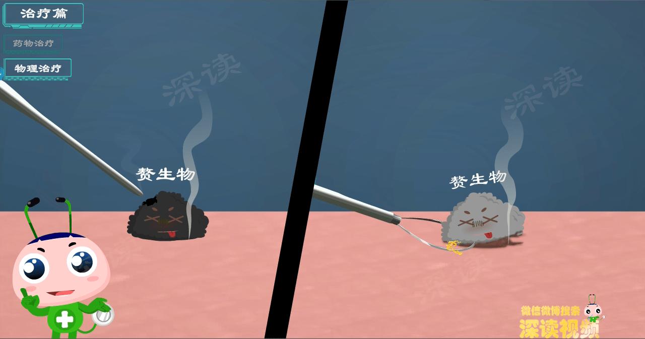 液氮冷冻治疗尖锐湿疣,冷冻和激光治疗尖锐湿疣的效果