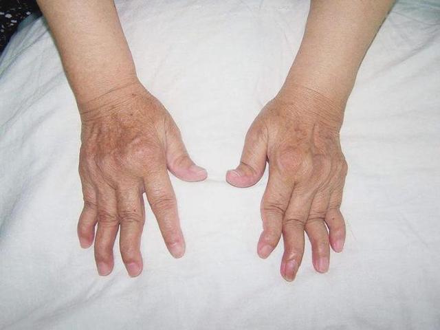 这些病因容易导致类风湿！日常生活需要注意这些点滴才能避免