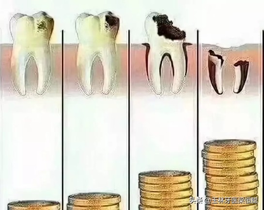 小洞不补大洞吃苦如何理解,小蛀牙洞怎么治疗好得快