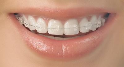 吴宣仪做牙齿前后对比,吴宣仪做整牙