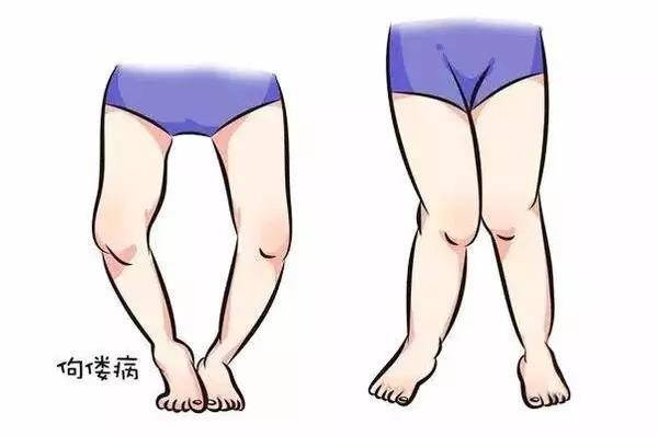 月子里宝宝不捆腿会罗圈腿吗,怕宝宝腿弯怎么去处理