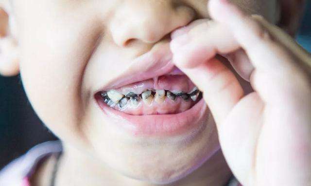 6岁孩子蛀牙发黑不配合怎么处理,3岁孩子蛀牙发黑怎么办