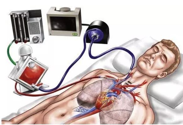 ecmo是危重症吗,ecmo能救猝死的人吗