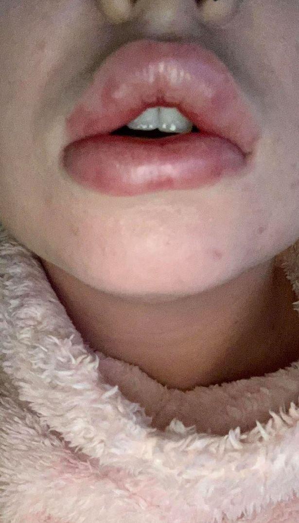 女子做丰唇手术超大嘴唇,做丰唇术嘴唇肿成香肠