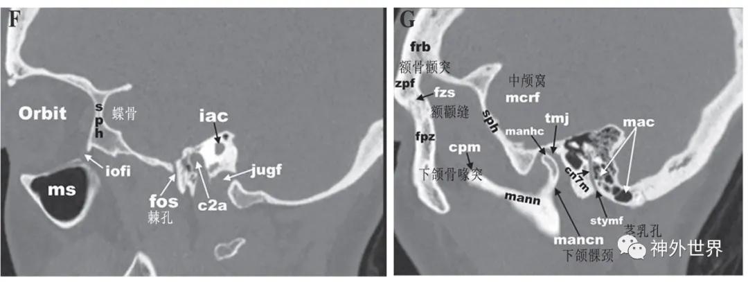 颅底骨折合并脑脊液漏伤情鉴定,颅底骨折伴脑脊液漏右眼眶骨折