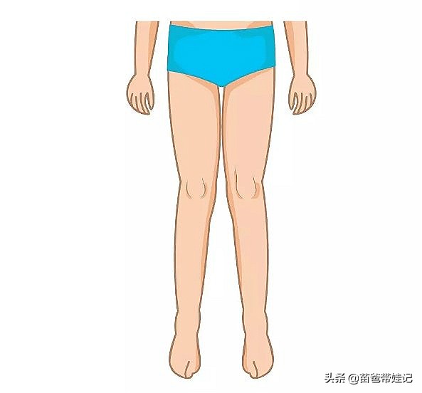 宝宝x型腿一定要治疗吗,宝宝x型腿例子