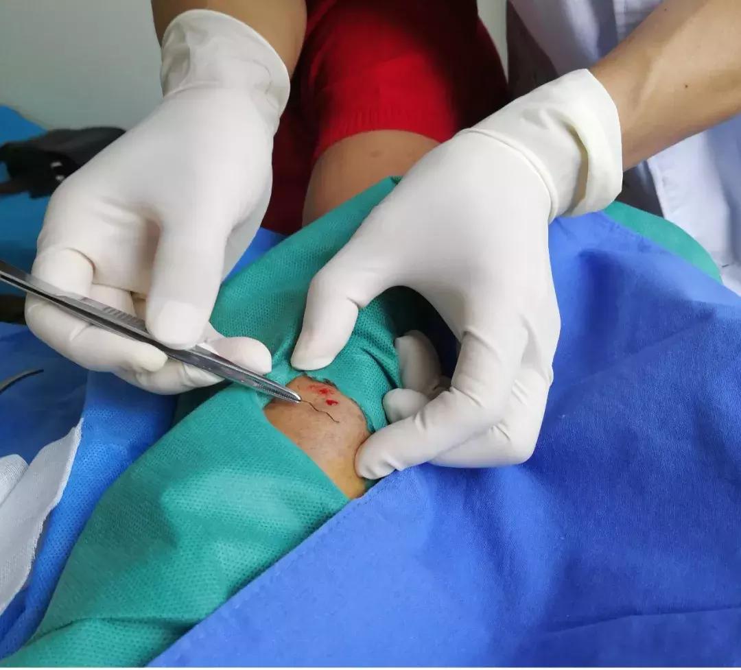 留置针导管会折断血管吗,留置针导管会折断吗