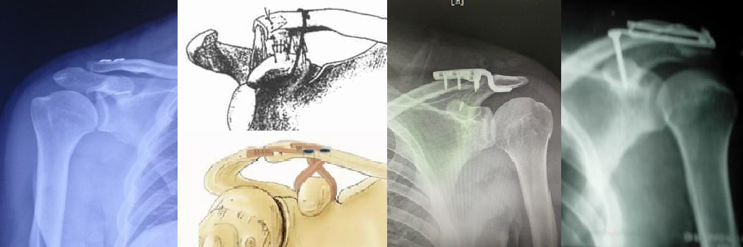 肩锁关节脱位复位视频,肩锁关节脱位固定带