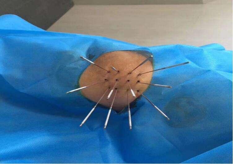 针灸治疗肿瘤的临床现状与展望,针灸市场发展风险