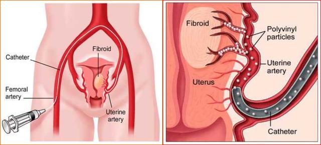 子宫肌瘤介入栓塞造影剂作用,子宫肌瘤介入栓塞有副作用吗