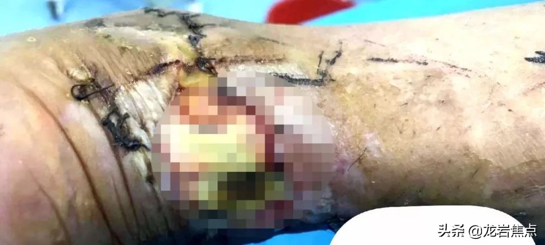 整块皮没了怎么处理,整块皮肤没了会增生吗