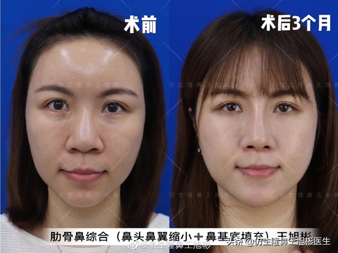 大鼻头缩小的改善原理,鼻头毛孔粗大如何改善缩小毛孔