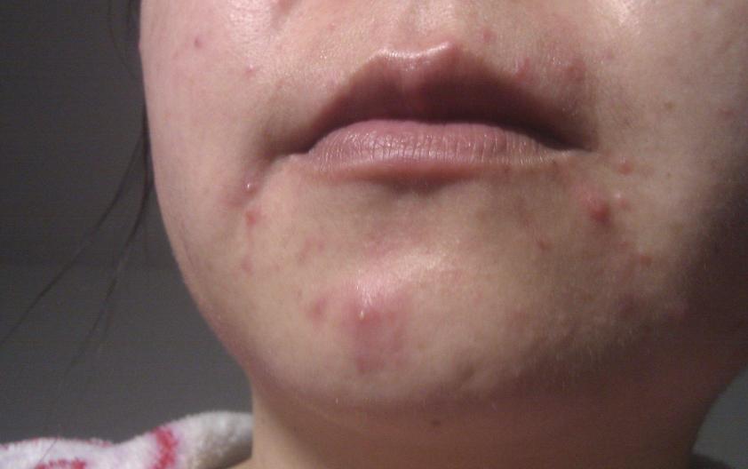 背部爆痘用什么药,背部长痘原因以及怎么调理