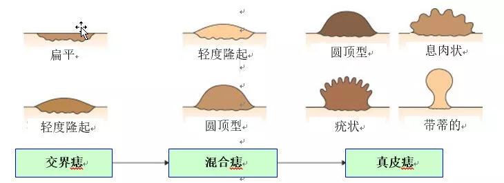 痣能点吗,我的痣凸起来会癌变吗