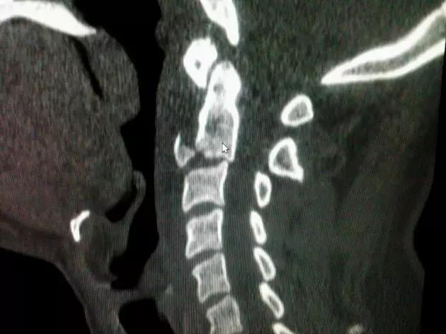几种严重骨折医学名称,常见的骨折有哪些名称