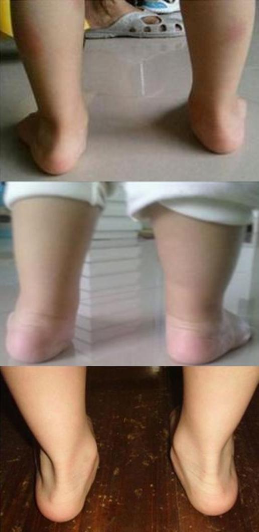 孩子足外翻该怎么办,孩子足外翻是怎么回事