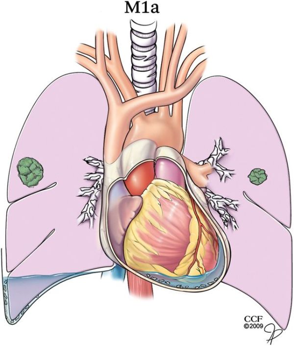 肺癌早期和晚期怎么判断,肺癌早中晚期如何区分