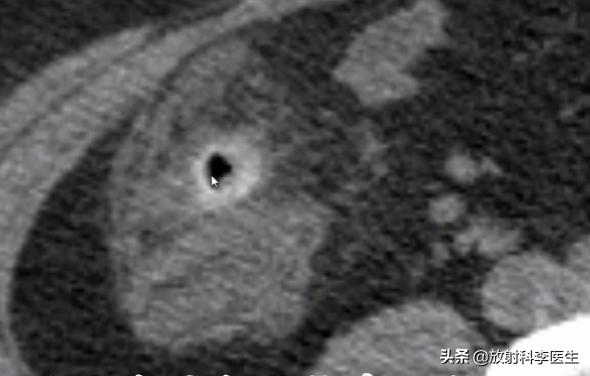 患者典型阑尾炎表现,为什么CT检查后李医生诊断为憩室炎?