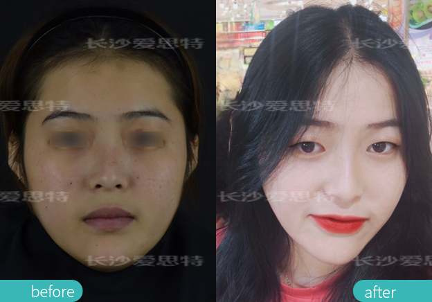 祛雀斑用皮秒好还是光子嫩肤好,祛斑用激光好还是光子嫩肤好一点