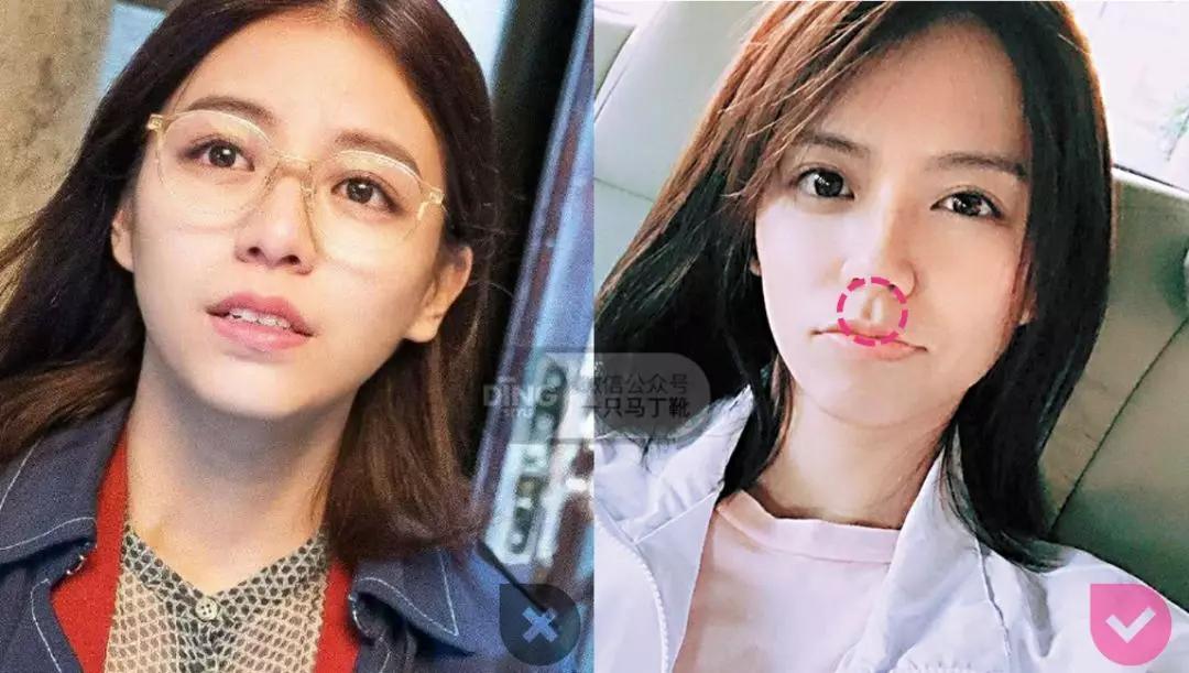 戴牙套凸嘴怎么化妆,凸嘴整牙削骨吗