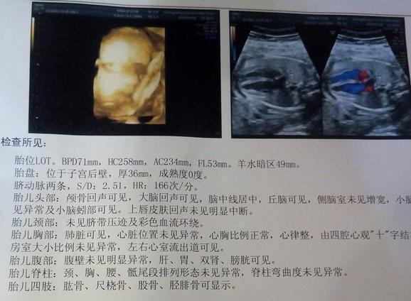 四维胎儿不配合老是蜷缩,胎儿四维不好做怎么办