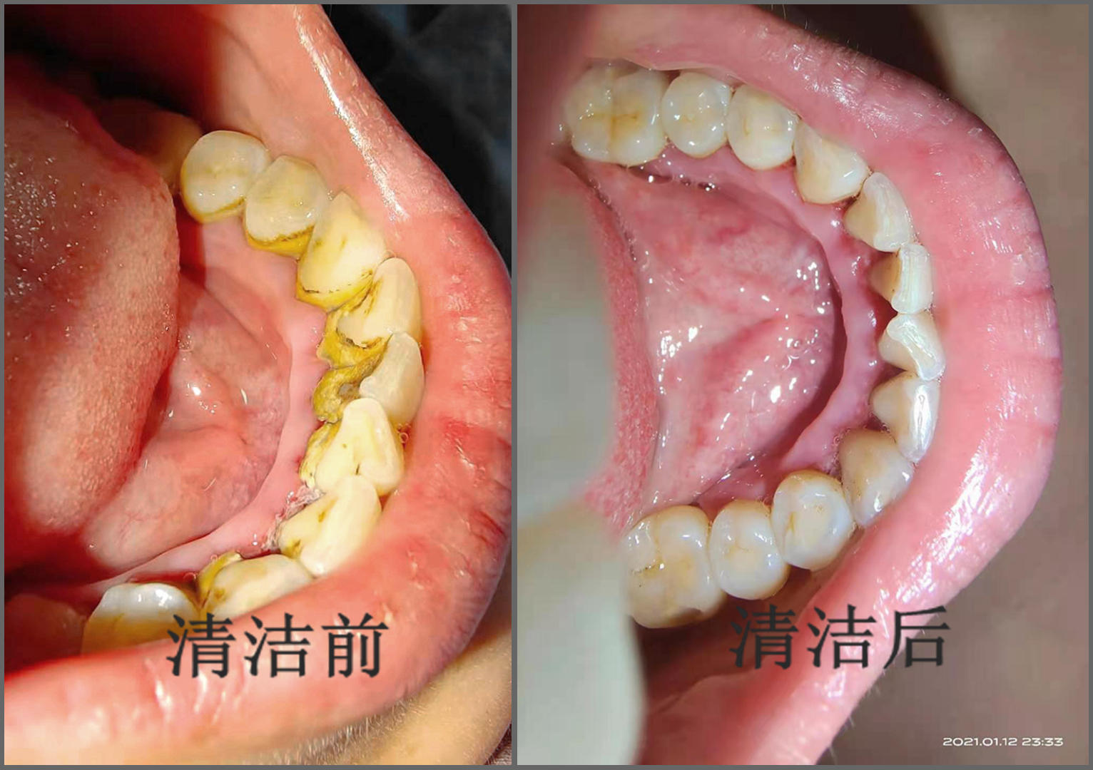 全球首款可视超声波洁牙仪,小米有品众筹已上线,仅199元