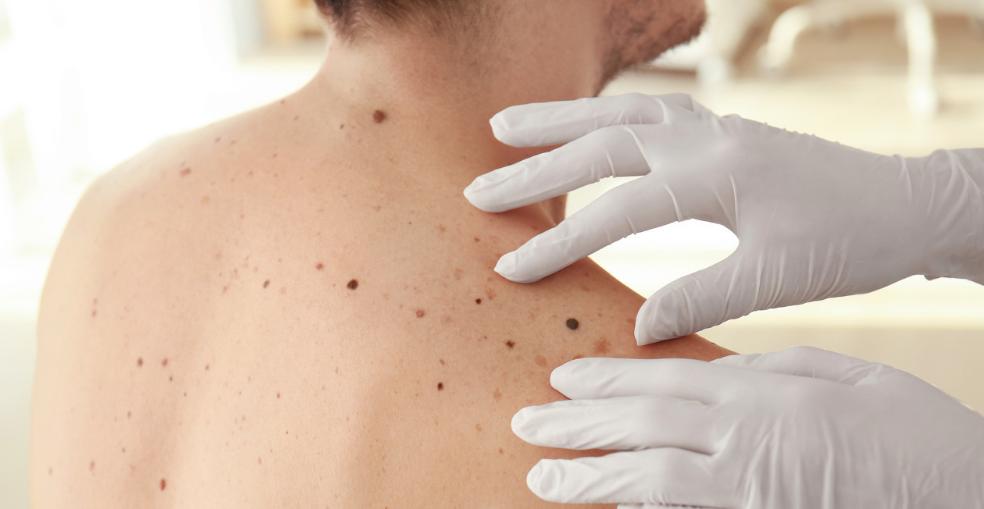痣恶变前的3个征兆,痣的恶变会有征兆吗