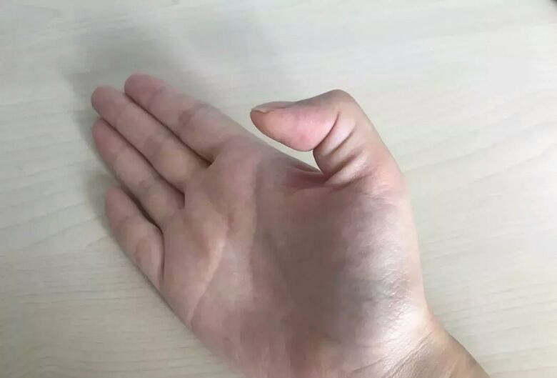 手腕肌腱囊炎初发怎么治疗,腕关节肌腱滑膜炎如何治疗