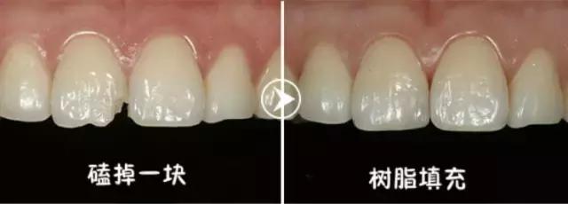 前牙磕掉一个小尖怎么修复,换过的牙磕掉了一小块怎么修复
